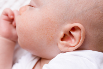 Красные прыщики на лице у новорожденного: симптомы, причины и лечение |  MUSTELA