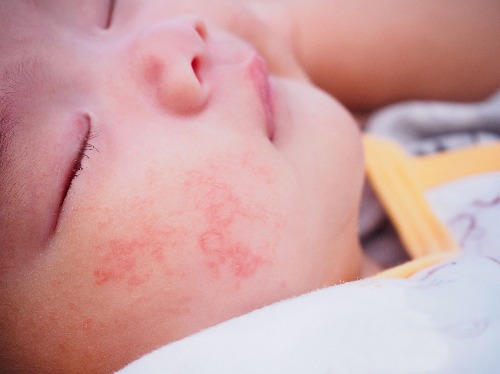 Что может вызывать развитие дерматита у грудного ребенка