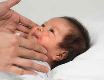 Атопический дерматит на лице у детей – определение и уменьшение дискомфорта